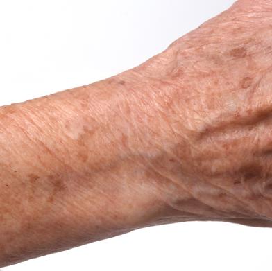 dull skin