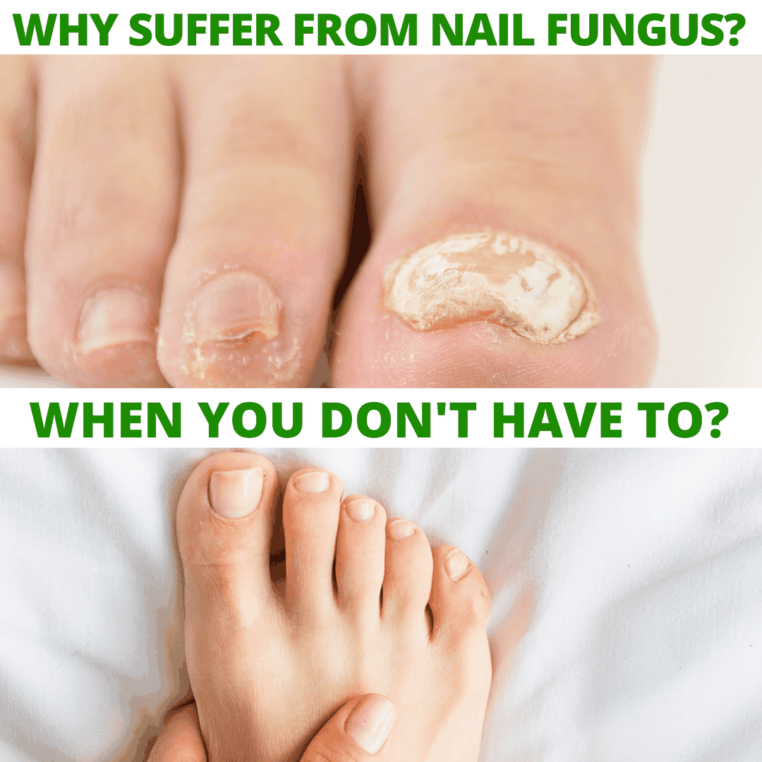 Why suffer from nail fungus when you don't have to?