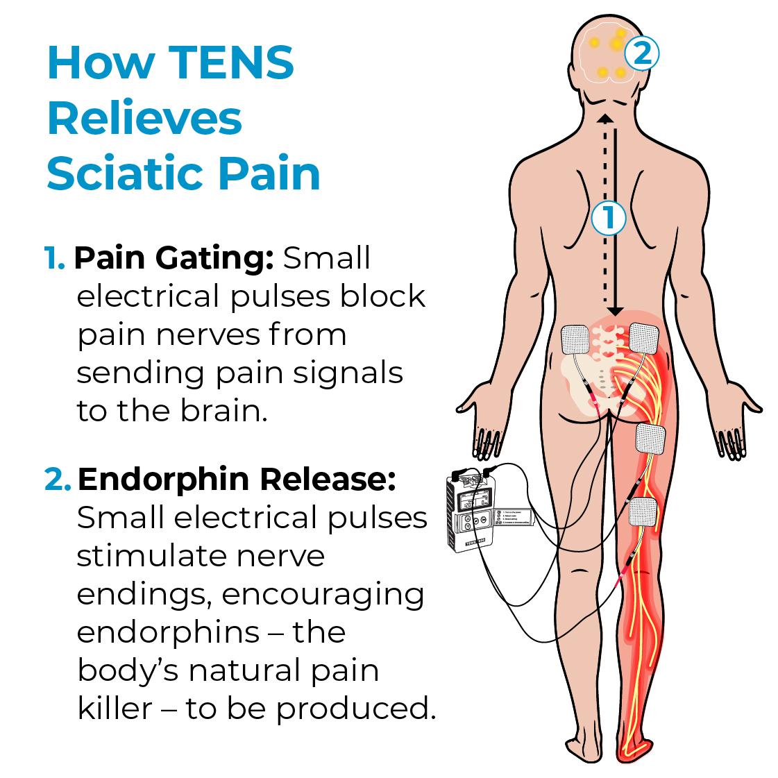 TENS pain therapy for sciatic pain