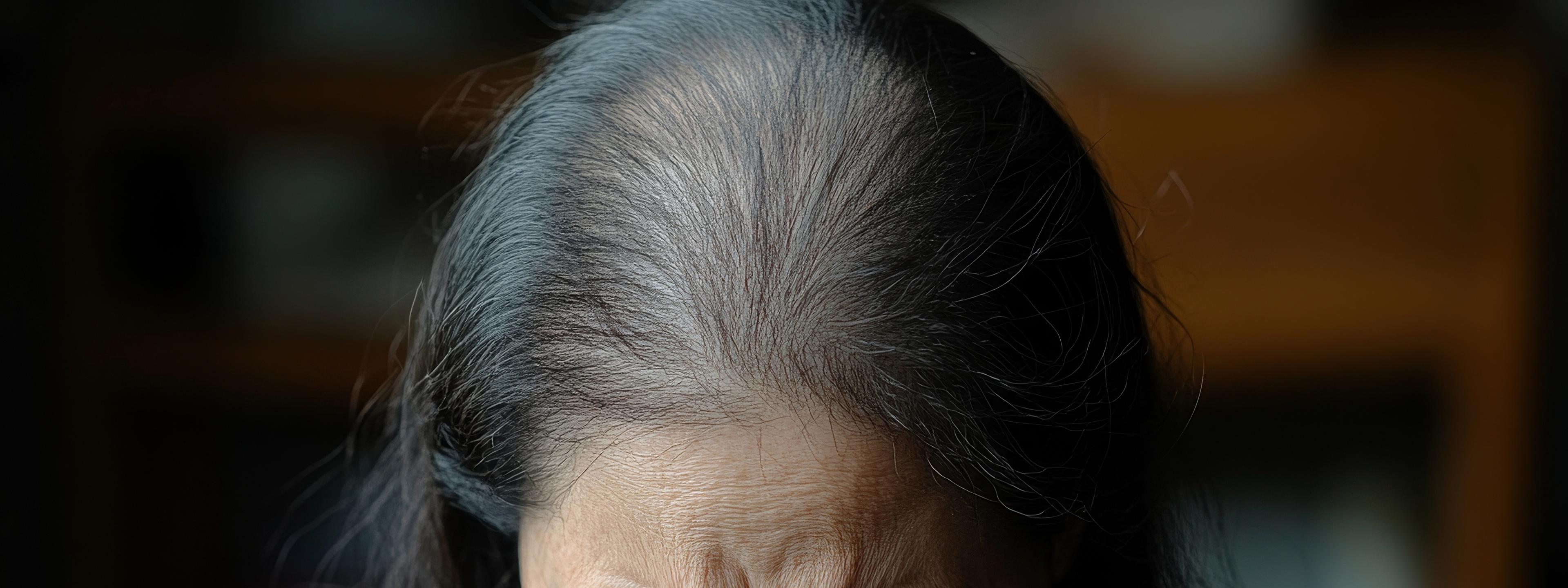 Balding - Women in her 60s - Desktop