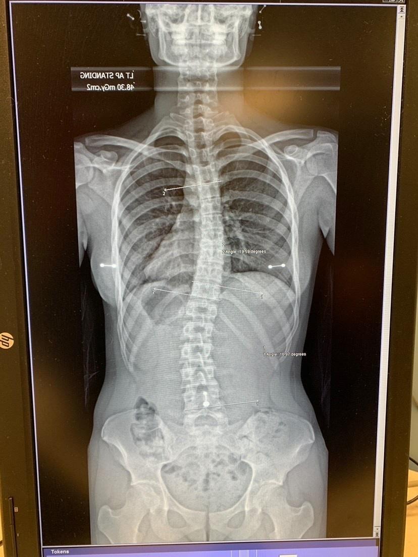 Four (4) More Fascinating Pictures of Body Jewelry in XRays