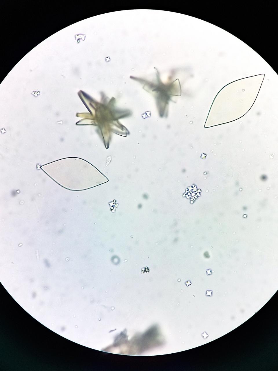 Urine Test Microscopic urinalysis, Uric Acid, Calcium oxalate.