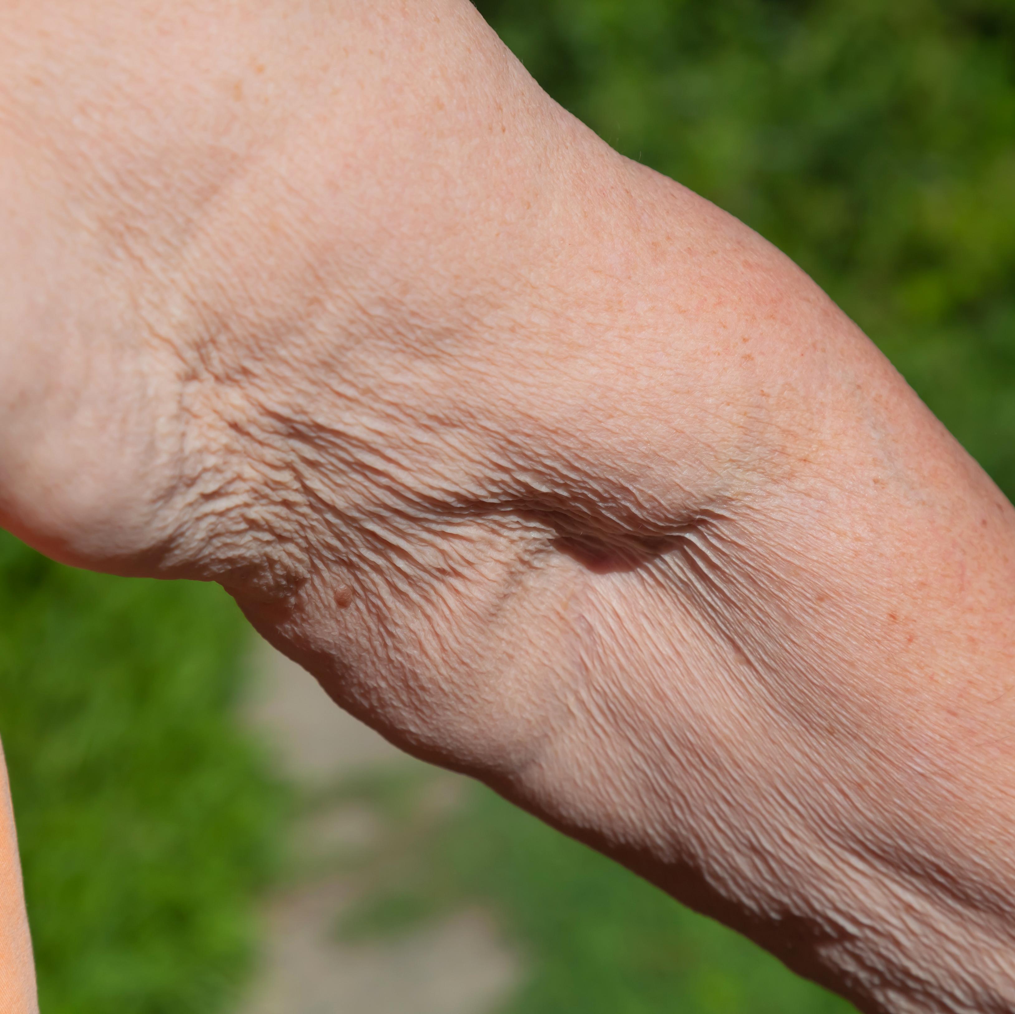 Crepey Skin