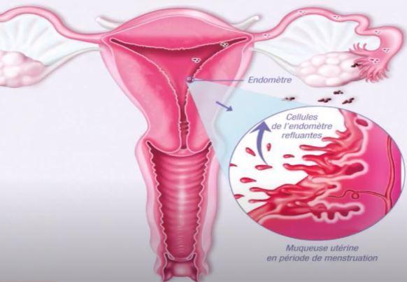 cellules de l'endomètre refluantes