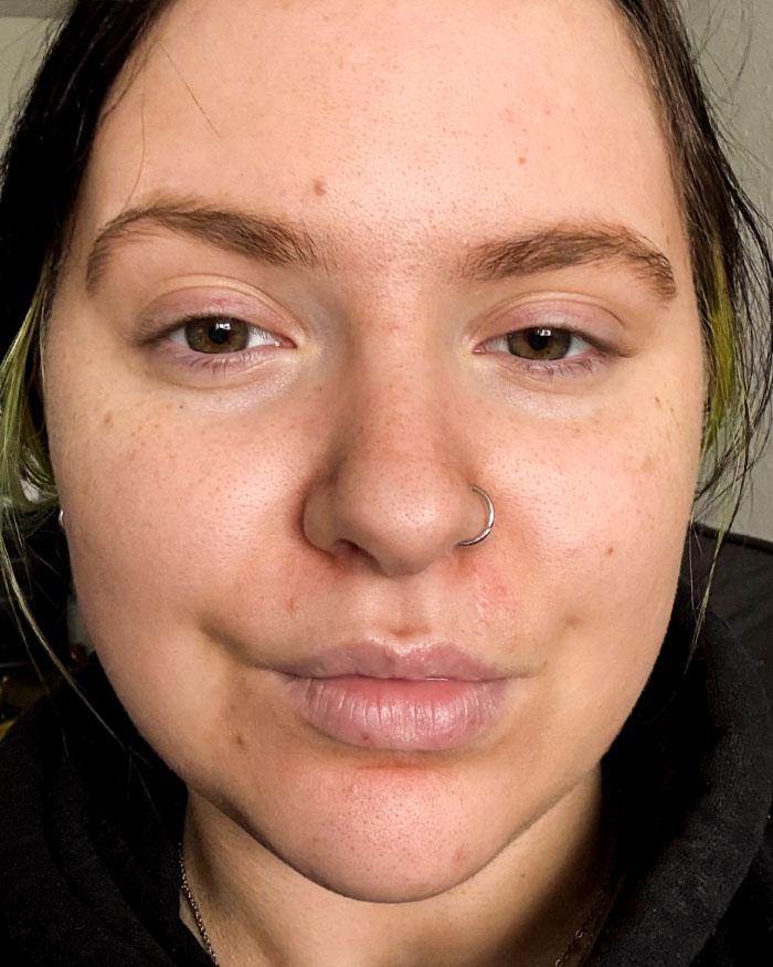 After photo of Aria, one month after using Clearizy, with clearer, smoother-looking skin.