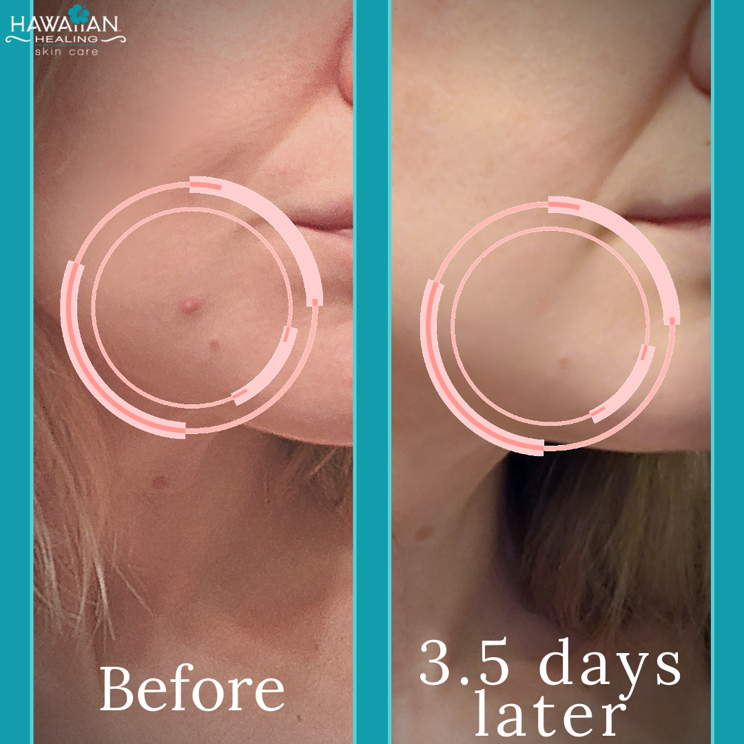 CLEAR Acne Treatment  Hawaiian Healing Skin Care