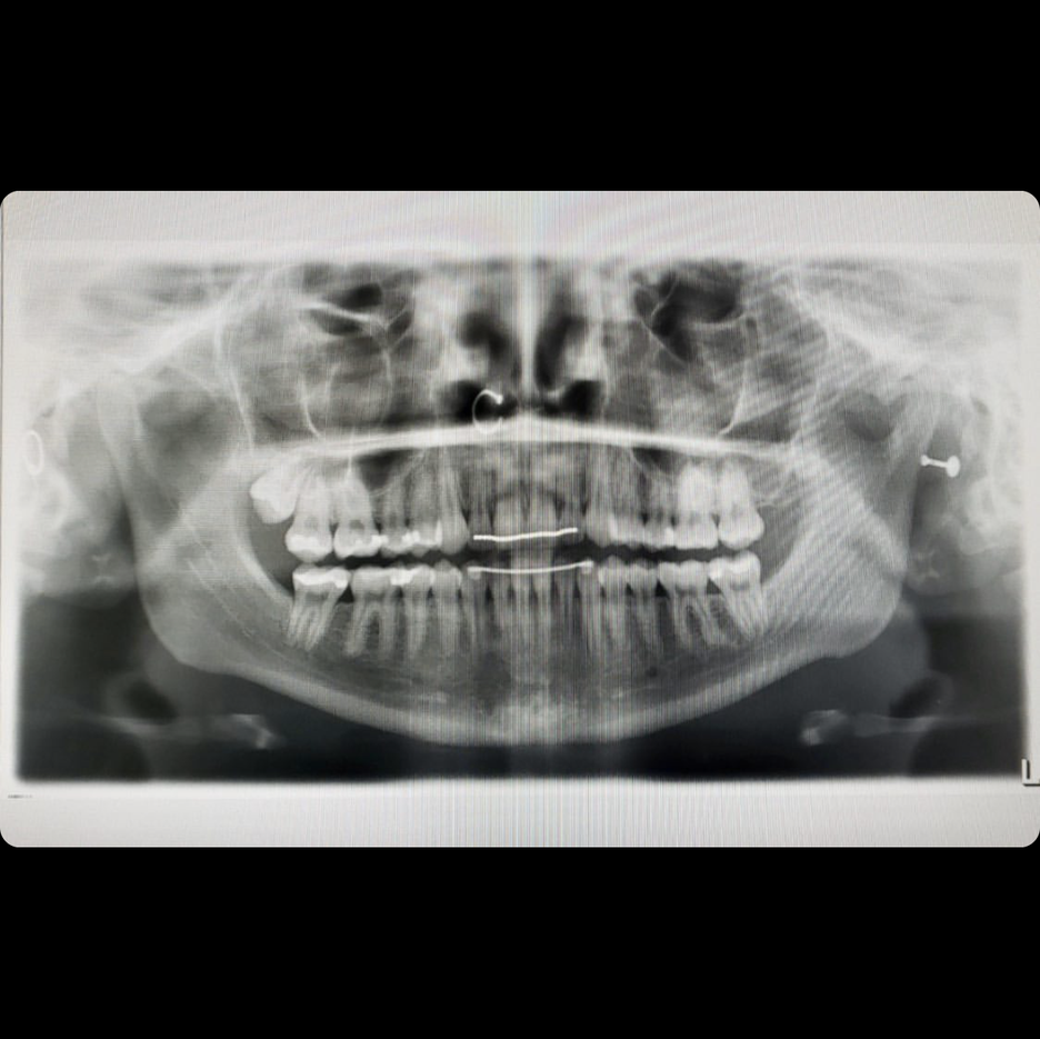 10 Fascinating Pictures of Body Jewelry in XRays BodyCandy