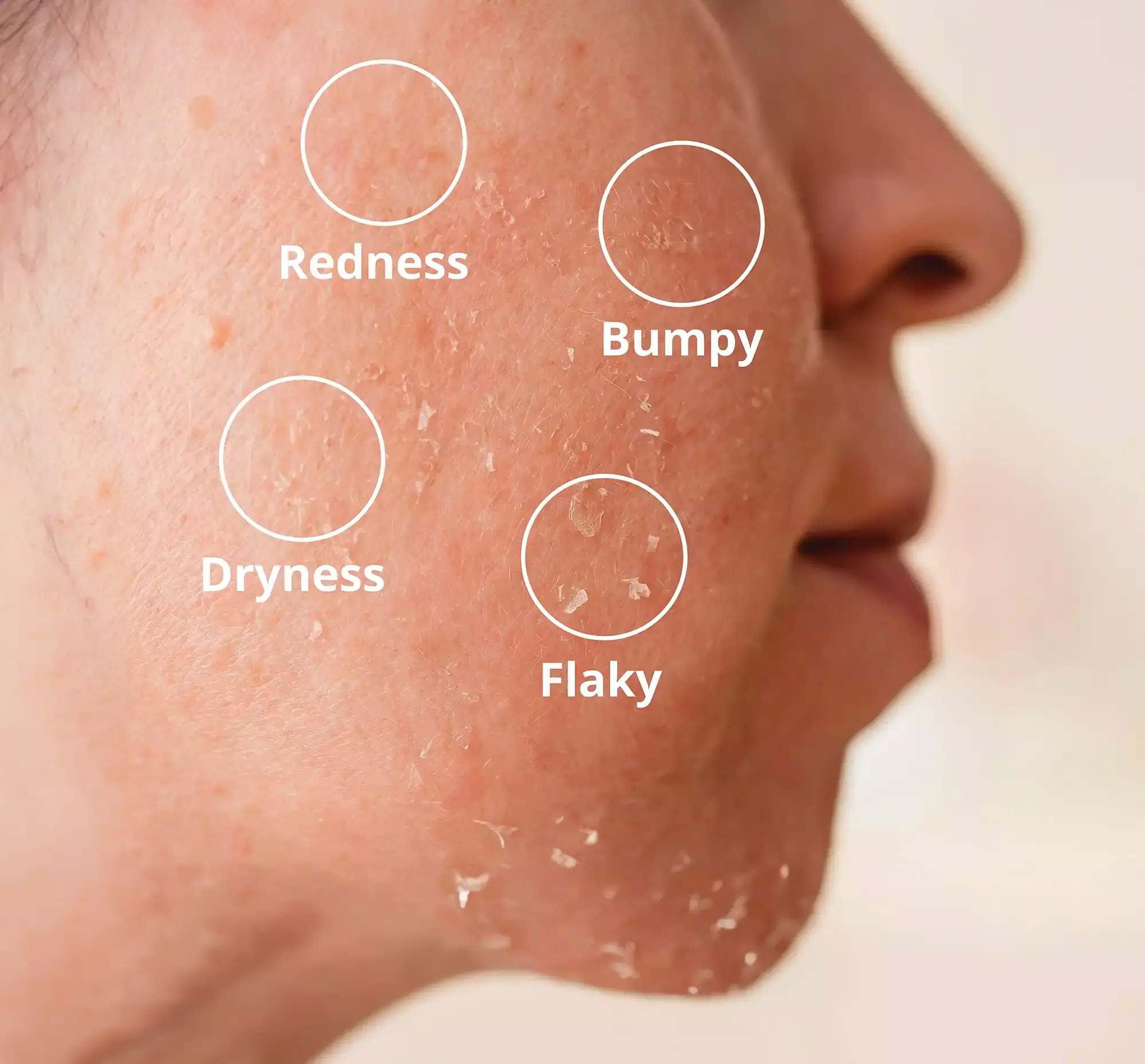 Redness, bumpy, dry and flaky skin