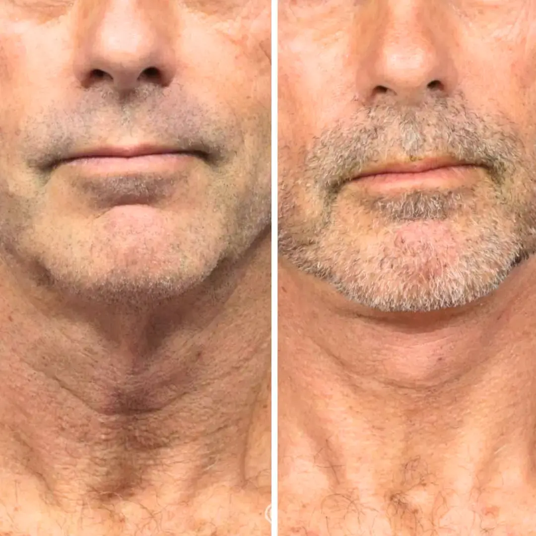 before after image of male in his 50's showing improved appearance of turkey neck