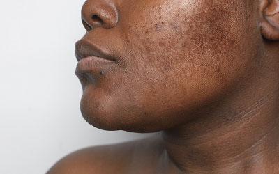 dark patches