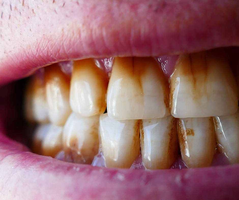 Upala Zubnog Mesa Gingivitis Uzroci Simptomi I Liječenje