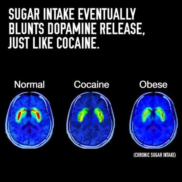Brain Scan Obese Normal Cocaine Sugar Sugar Intake Dopamine