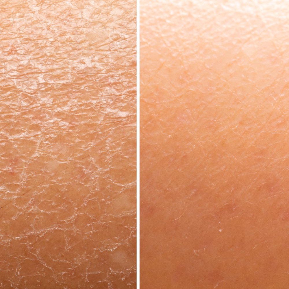 difference and similarities between dry and dehydrated skin