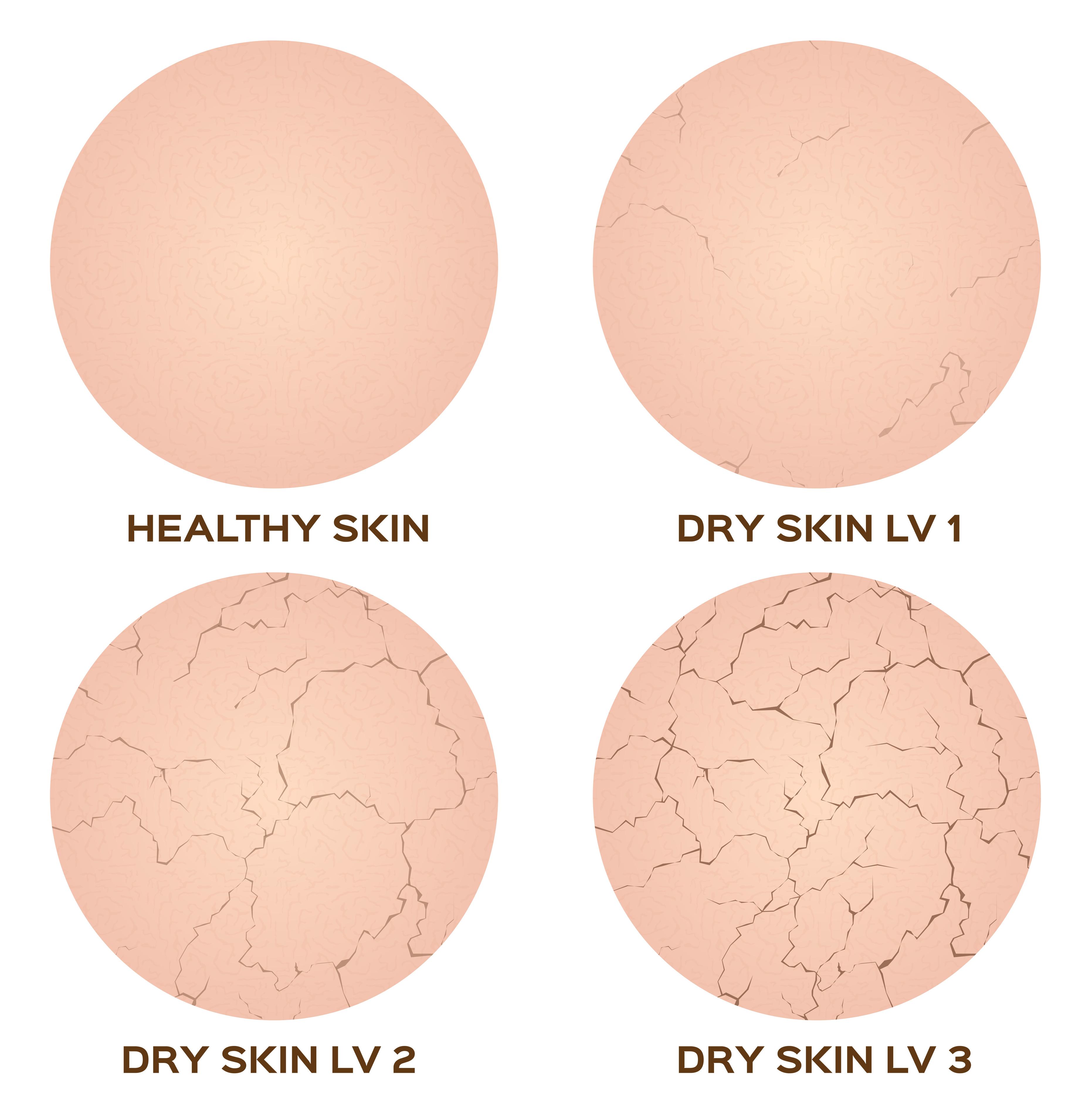 Dry skin type