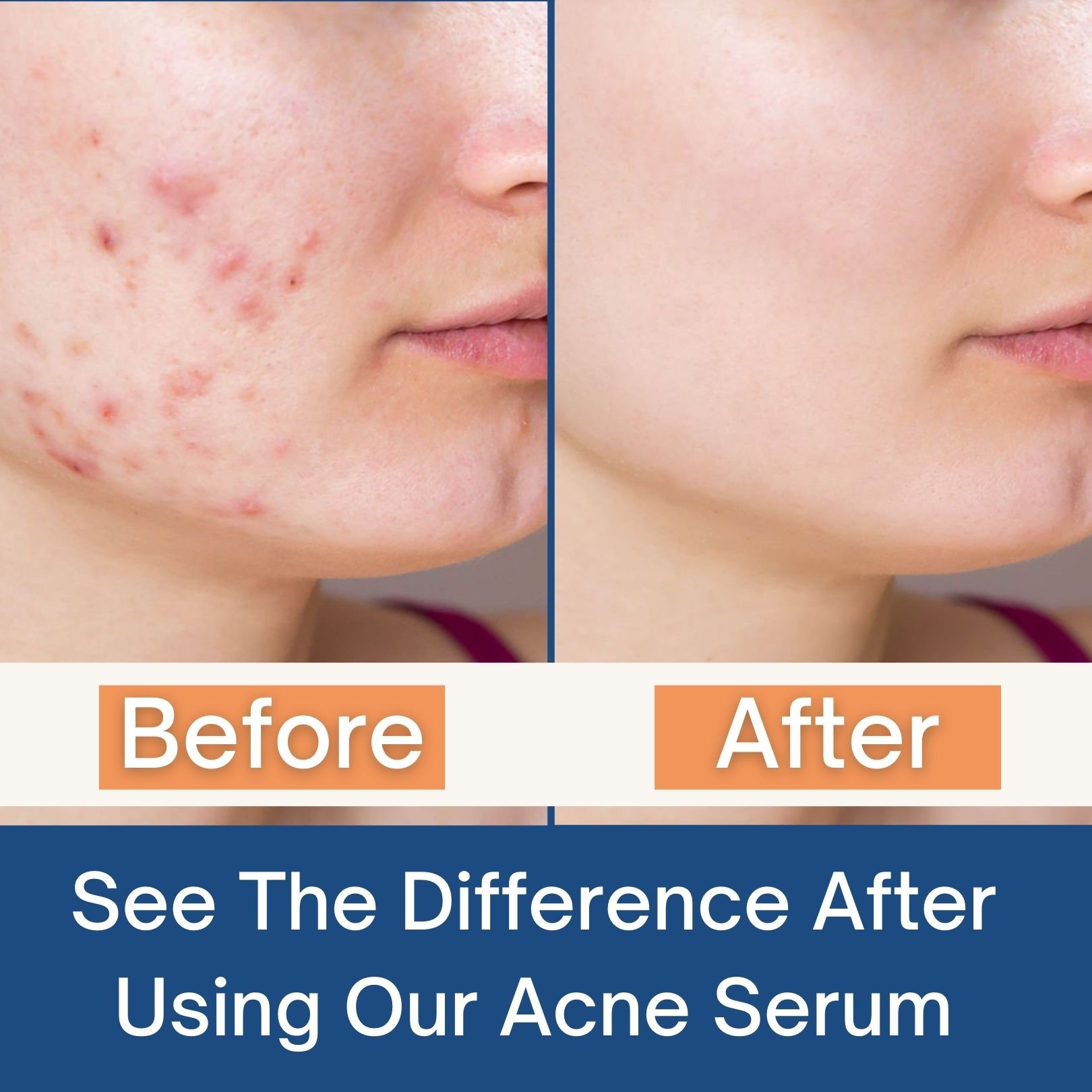 Salicyclic acid before and after