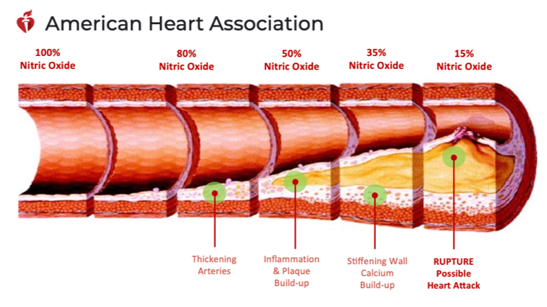 graphic showing plaque build up gradually in an artery