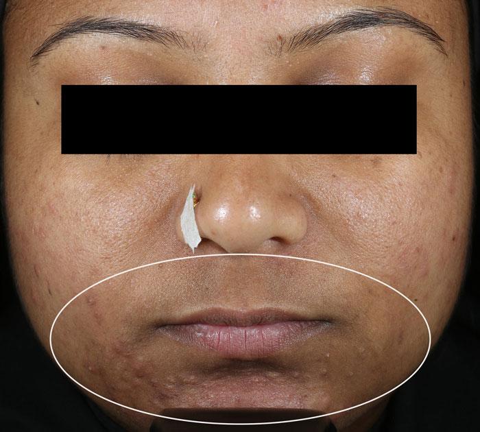 Acne breakout in participant on day 1