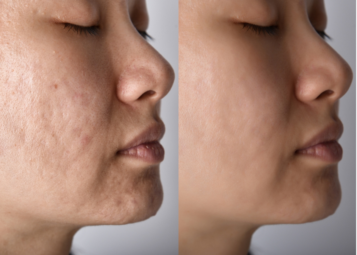 before and after photo acne scars