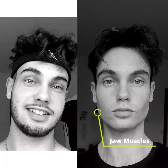 Before and after jaw workout sale