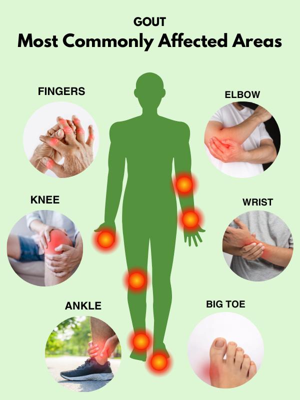 Most commonly affected areas by gout: fingers, knee, ankle, elbow, wrist, big toe