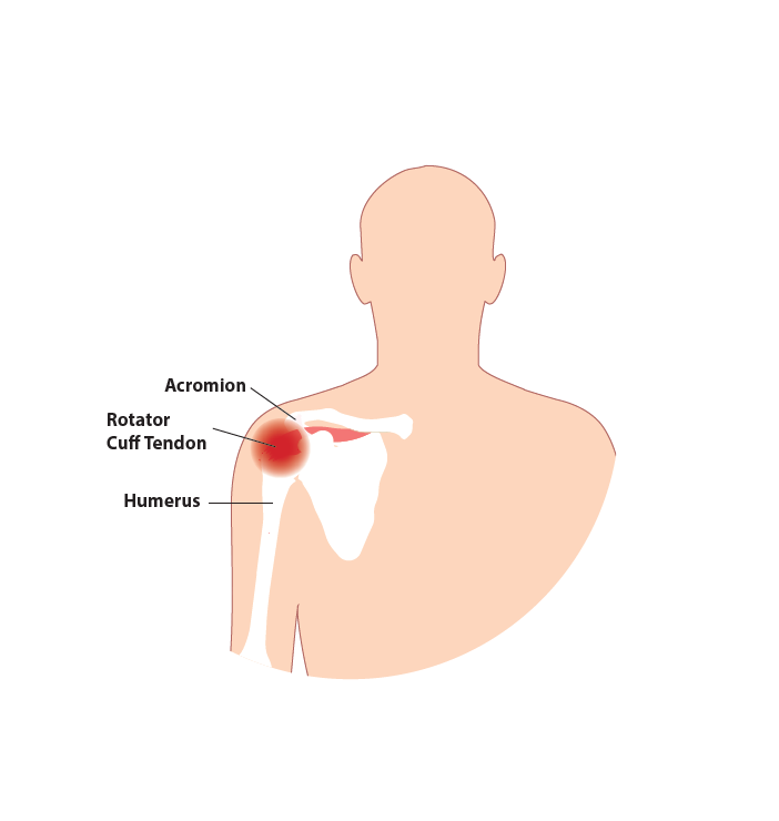 Soft tissue can become pinched in the subacromial space, which can cause impingement pain.