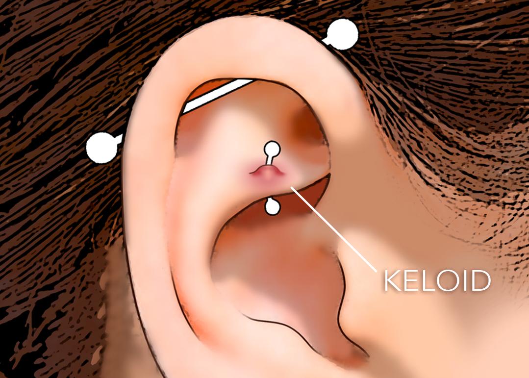 rook piercing keloid