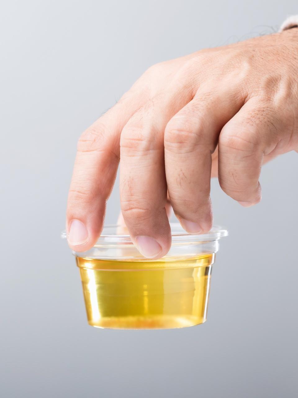 A hand holds a clear sample cup filled with yellow urine for testing.