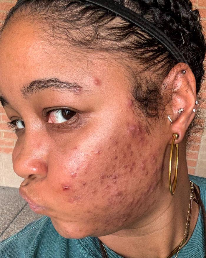 Before photo of Glynis showing acne and skin texture.