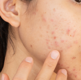 Different types of on sale acne scars