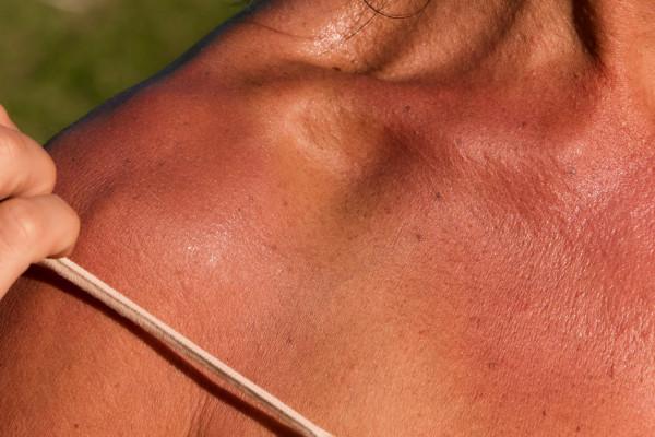 close-up of woman's sunburned shoulder.