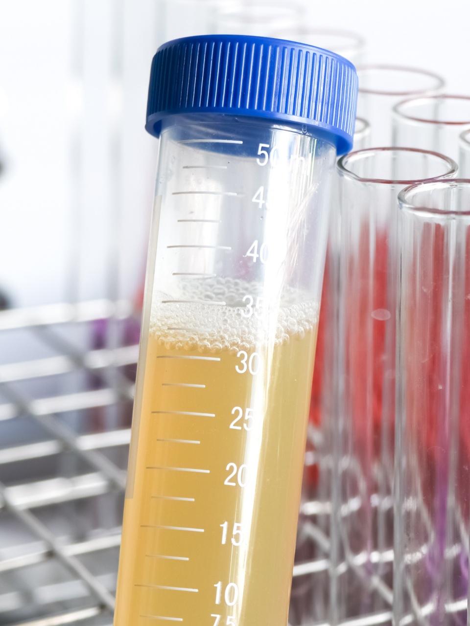 A close-up shows a foamy urine sample tube in a laboratory setting for testing.