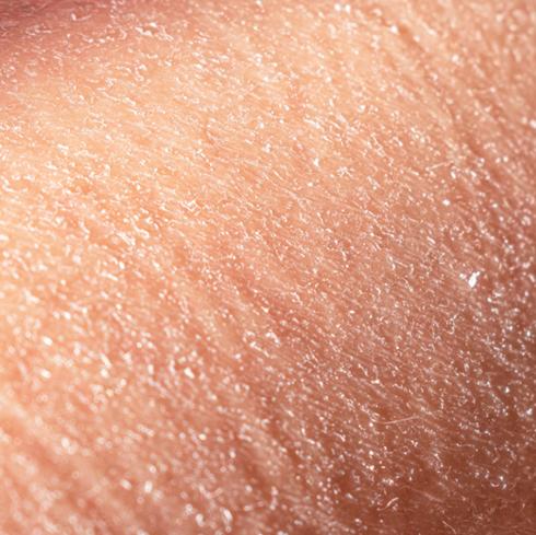 dry skin