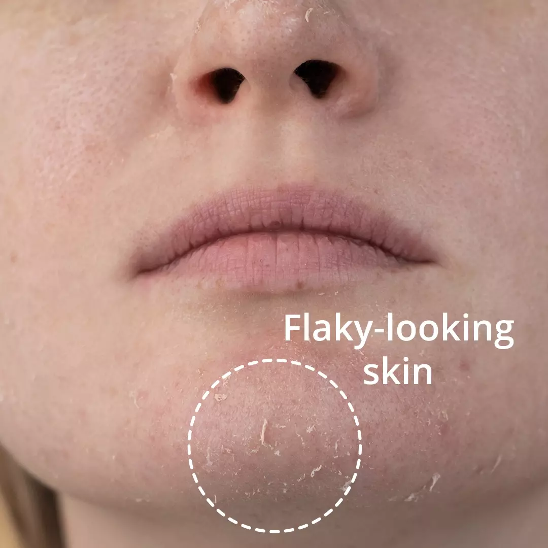 flaky-looking skin