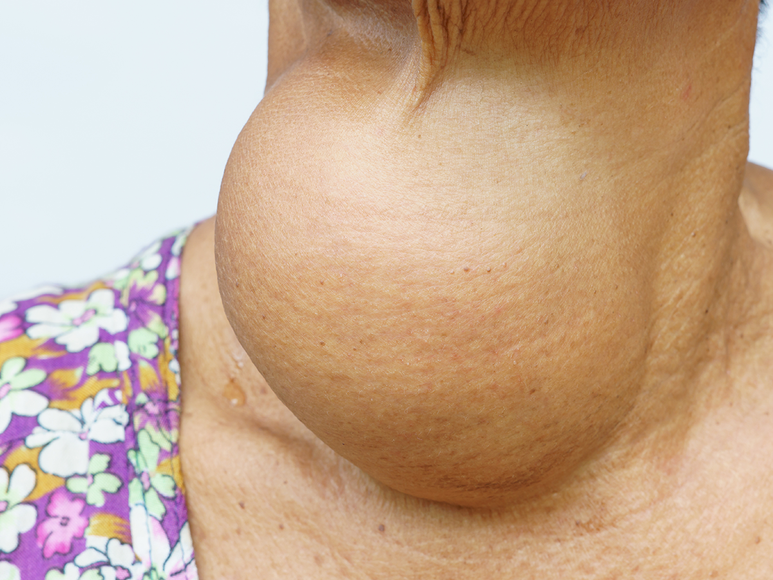 4 Thyroid Problems Caused By a Lack of Iodine