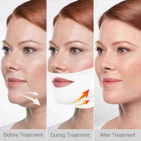 Stunning Beauty™ Face Slimming Mask