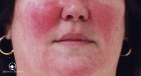 Red Faced… Are You Permanently Embarrassed or is it Rosacea?