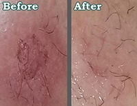 Before and after close-up images showcasing the healing process of skin. The 'Before' photo depicts skin with a rough texture and several dark, scaly patches. The 'After' photo shows the same area of skin with a smoother texture and a significant reduction in the appearance of the patches, indicating improvement from using the dermatological treatment.