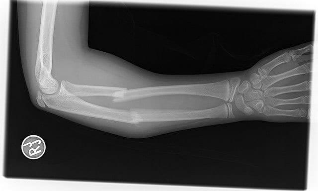 Broken bone arm image saltwrap