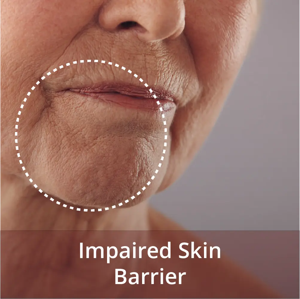impaired skin barrier