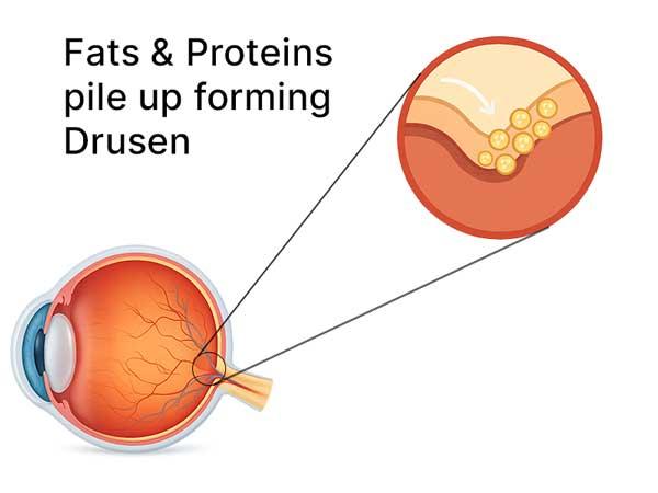 formation of drusen from protein and fat build up