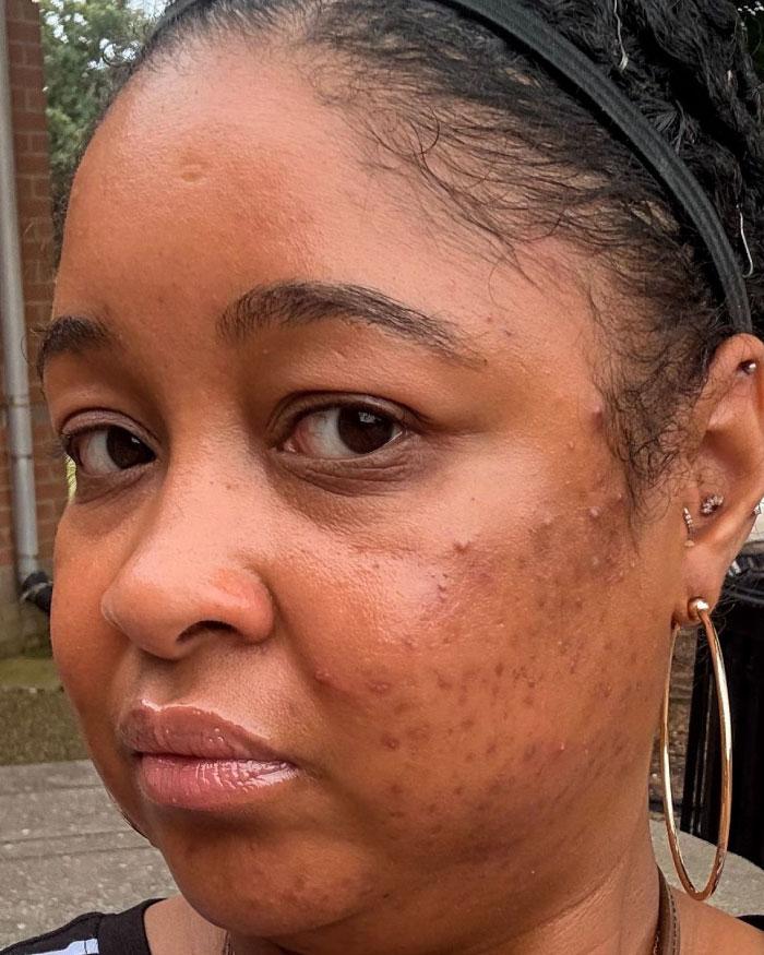 After photo of Glynis, one month after using Clearizy, showing visible skin improvement.