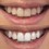 Whitens Teeth