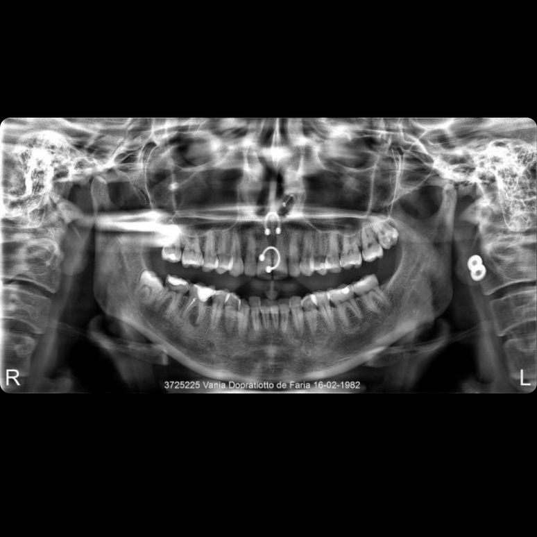 10 Fascinating Pictures of Body Jewelry in XRays BodyCandy