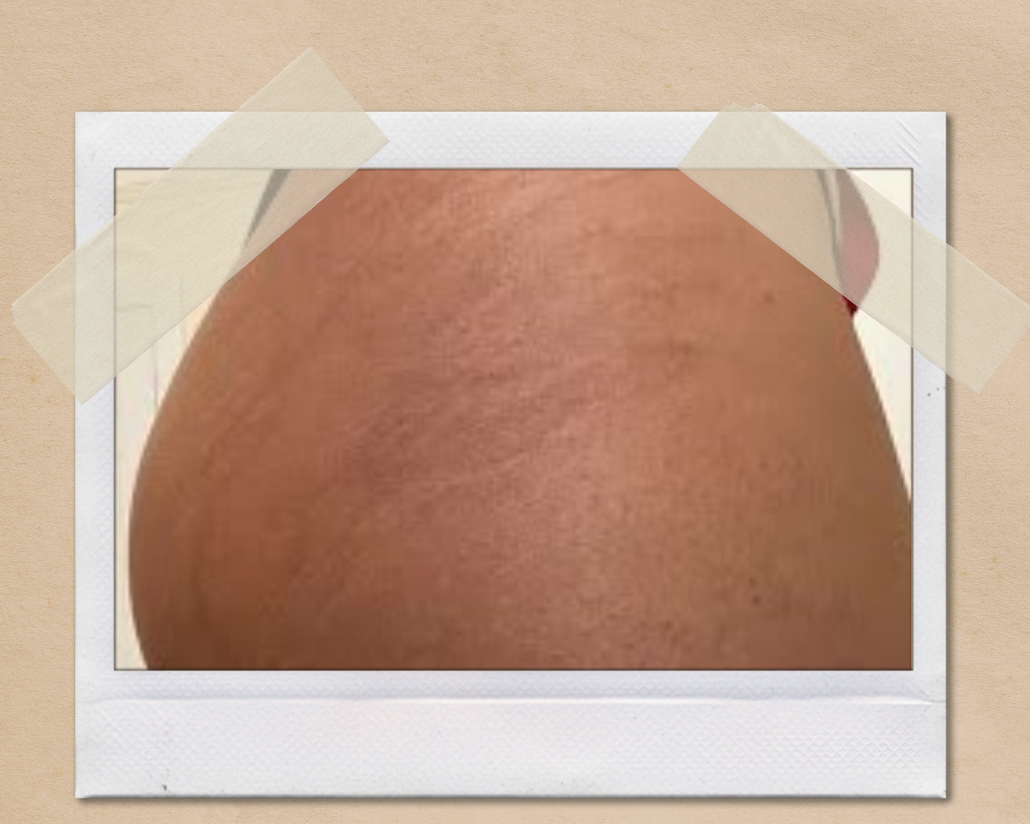 Undesired result for stretchmark's camouflage