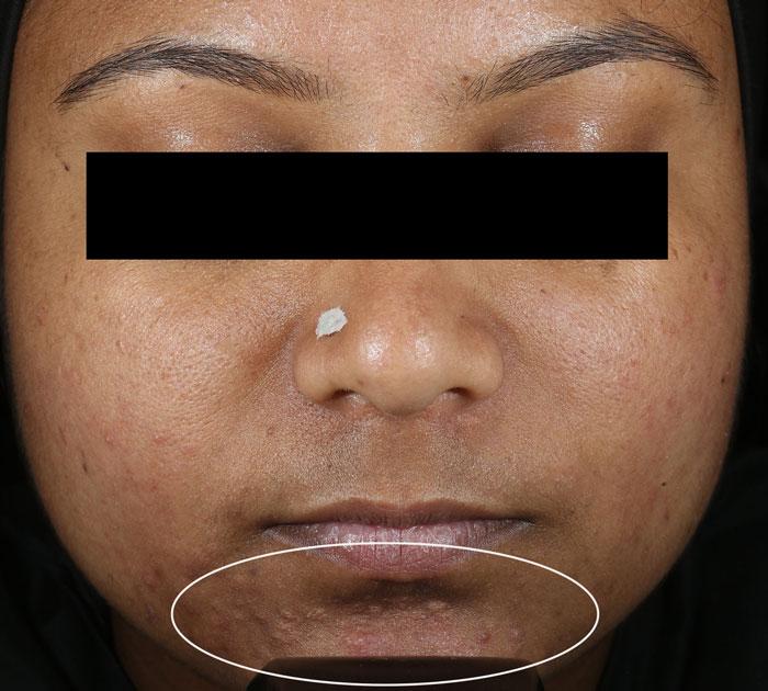 Acne breakout reduction in participant on day 56, after 8 weeks of consistent use of Clearizy