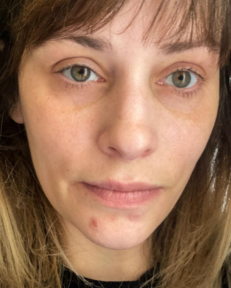 Before photo of Jessica showing blemishes and uneven skin texture.