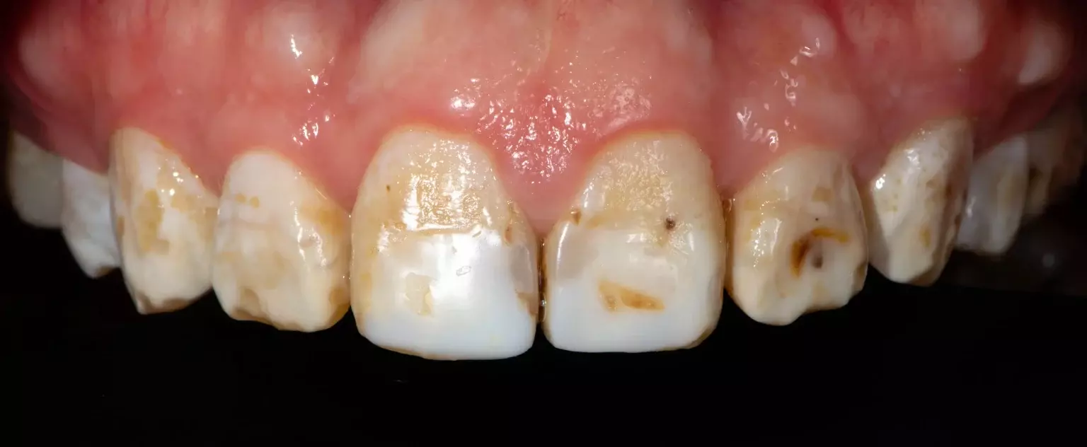fluorosis-in-the-enamel-1536x632