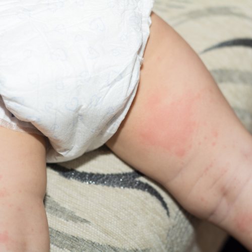 Nappy Rash baby