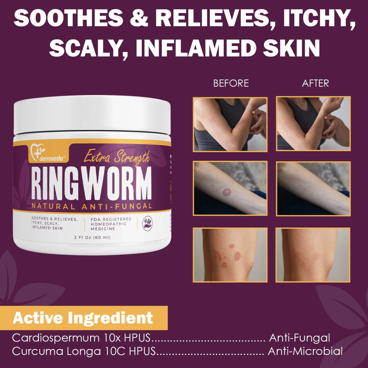 Ringworm Treatment Cream Fast Fungal Treatment Dermveda Ringworm Treatment Cream Fast Fungal Treatment Dermveda