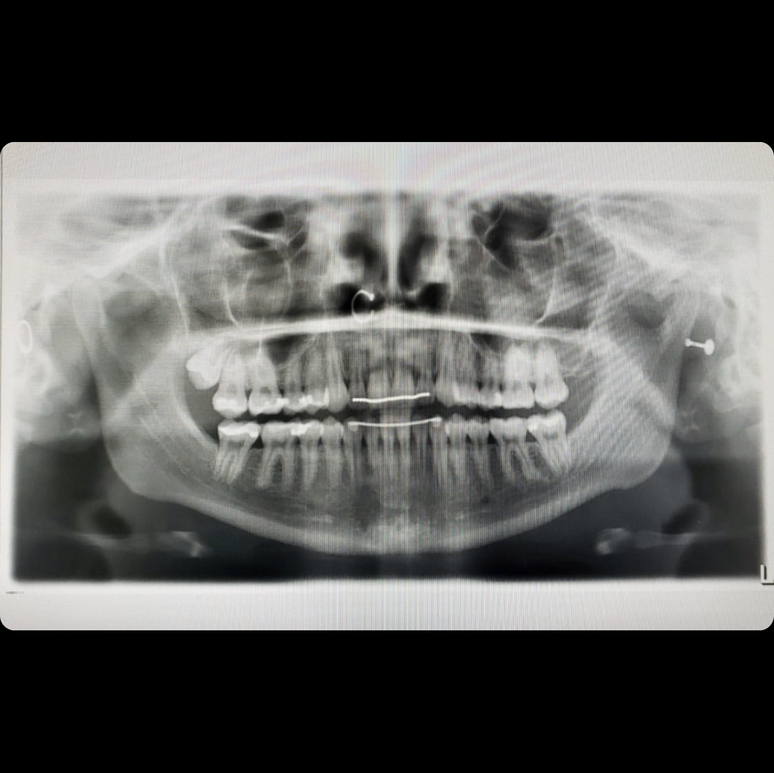 10 Fascinating Pictures of Body Jewelry in XRays BodyCandy